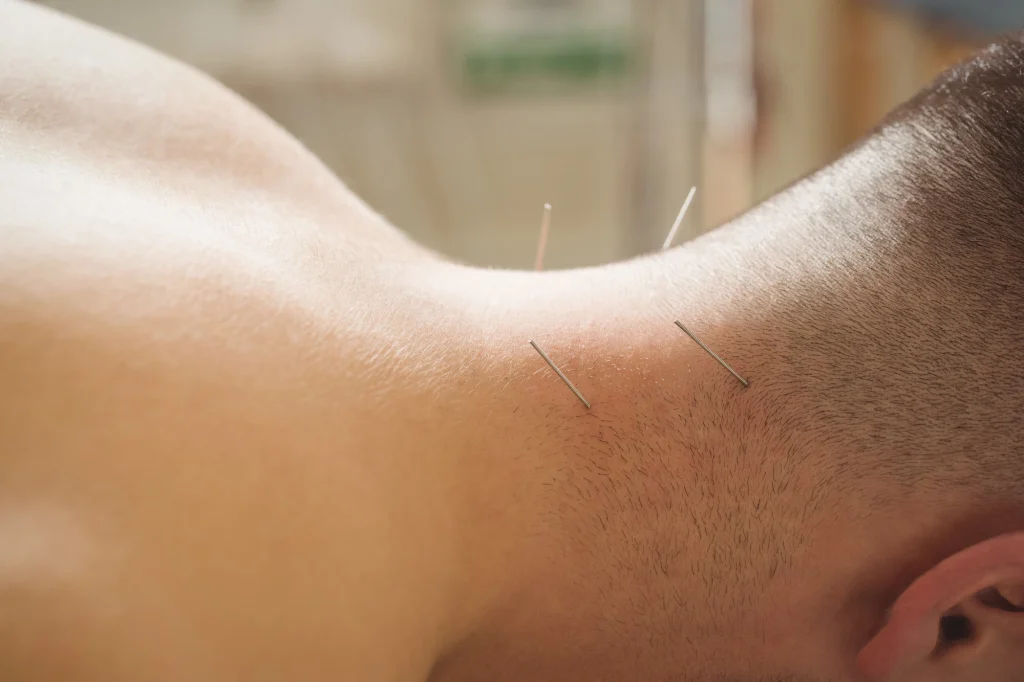 sports acupuncture near me