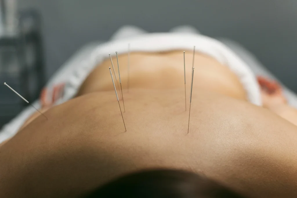 acupuncture for sciatica pain near me