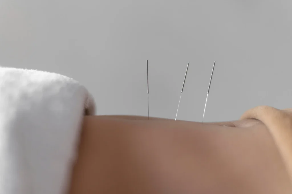 benefits of acupuncture for anxiety