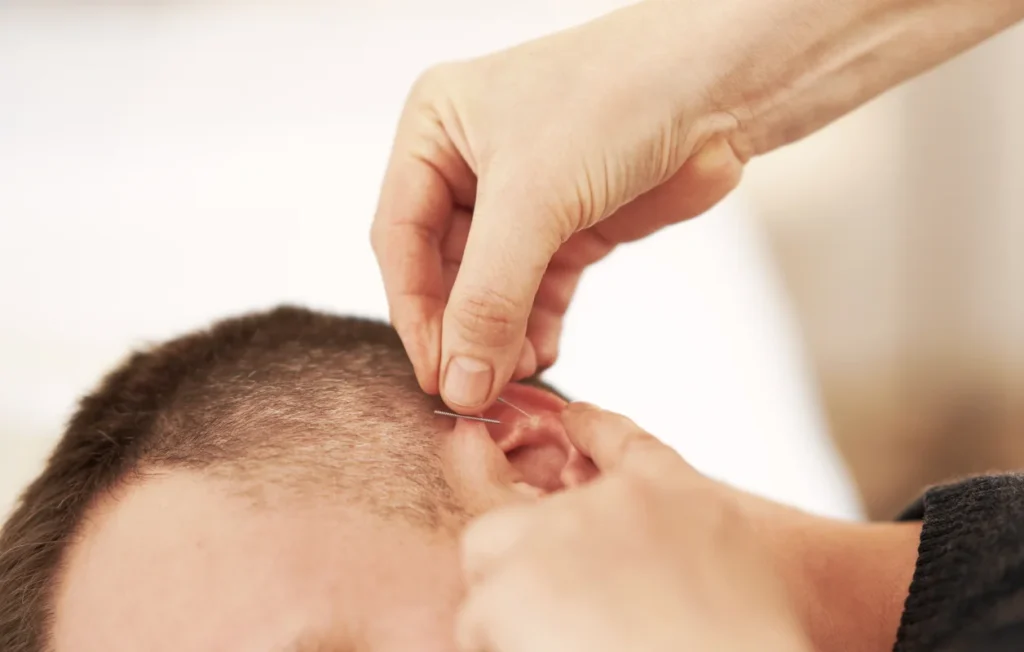ear acupuncture