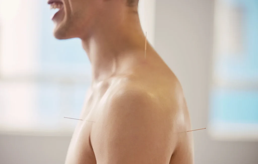 acupuncture for lower back pain