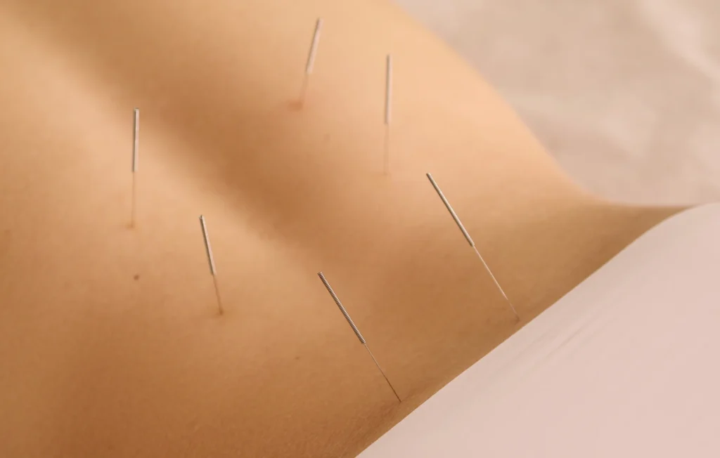 acupuncture for upper back pain