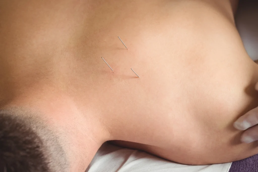 sports acupuncture