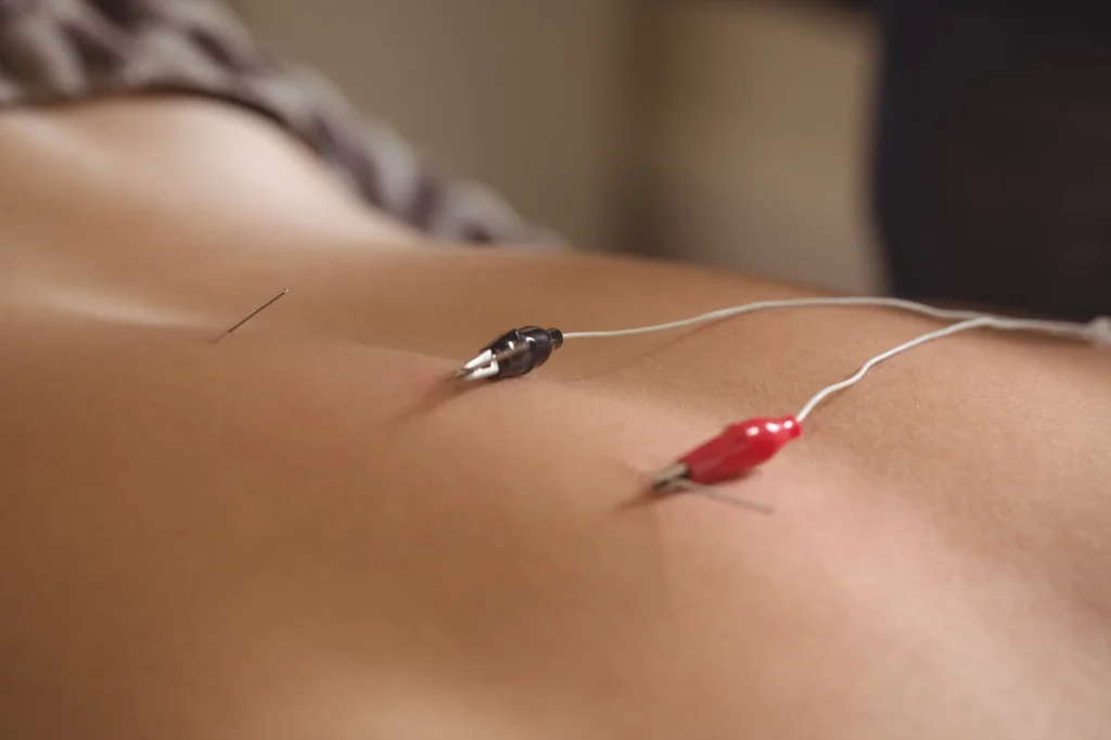 electro-acupuncture near me