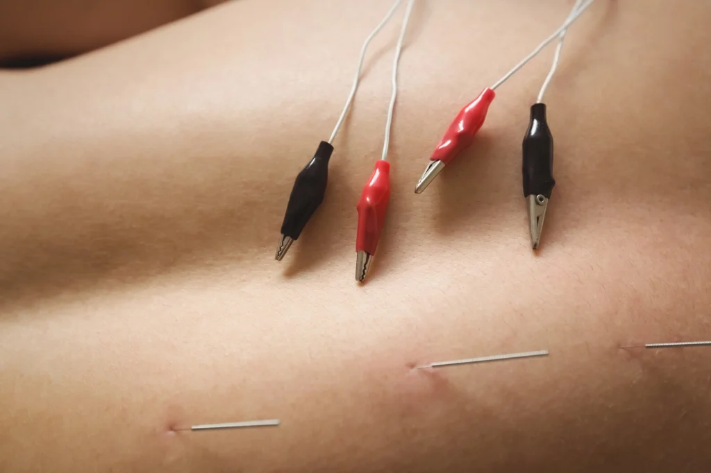 electro acupuncture near me