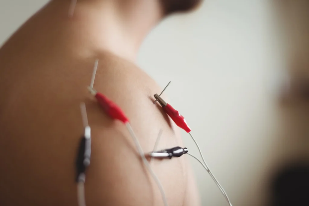 electroacupuncture near me