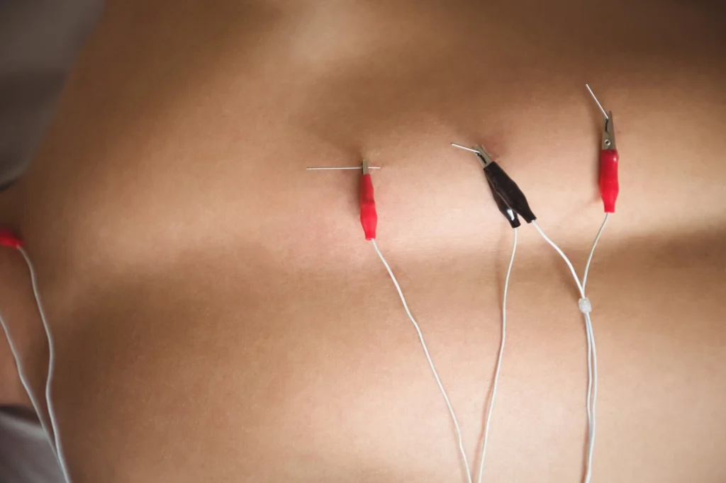 electroacupuncture cost