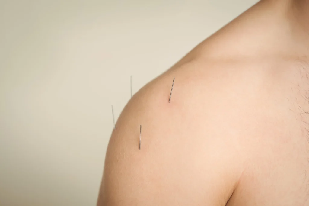 acupuncture in lincoln park