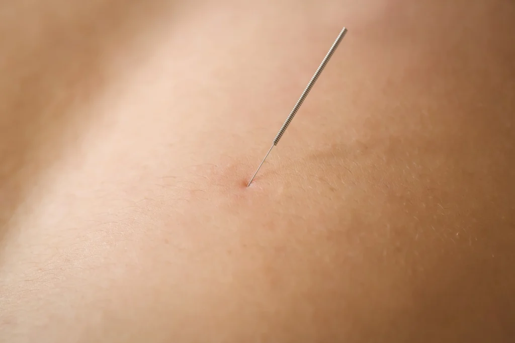 acupuncture in west town