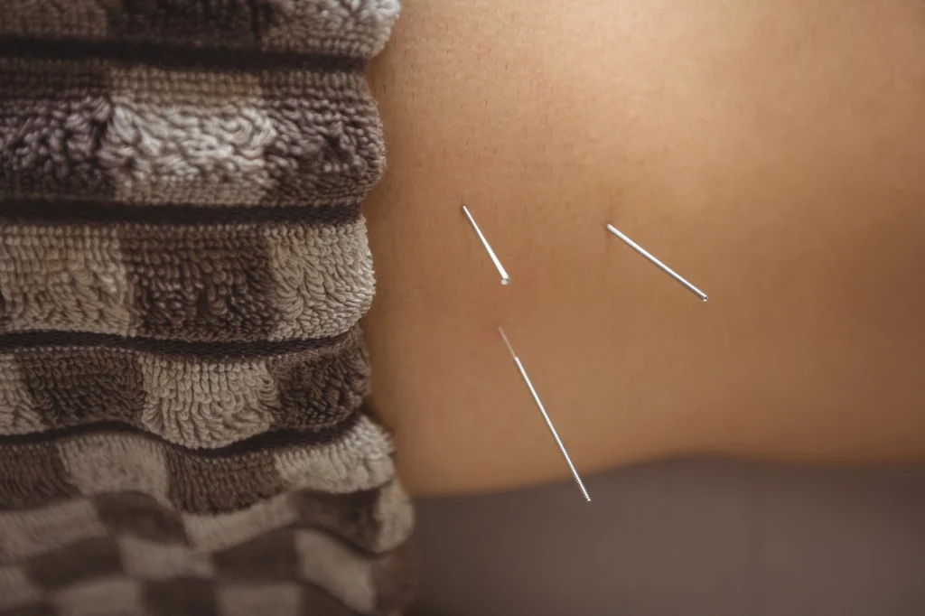 acupuncture near me