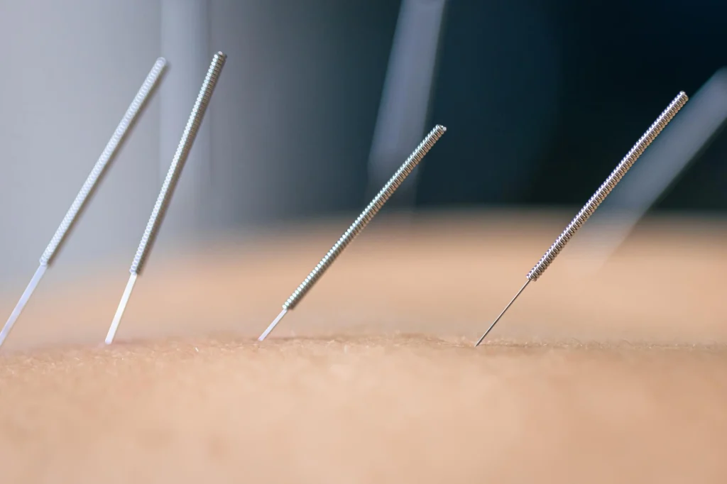 acupuncture points for migraines