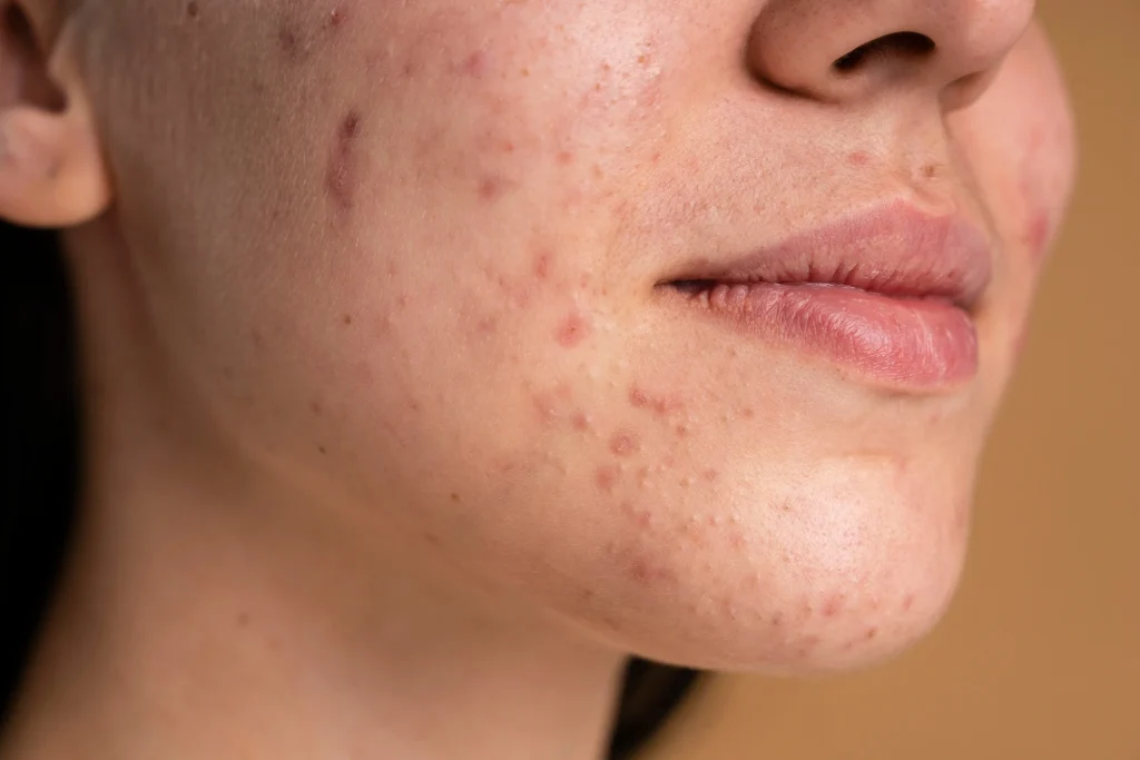 acupuncture for hormonal acne