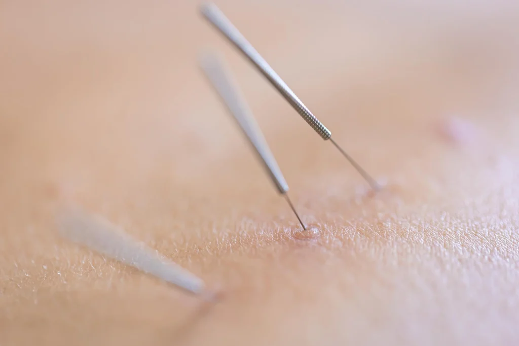 acupuncture points for acne