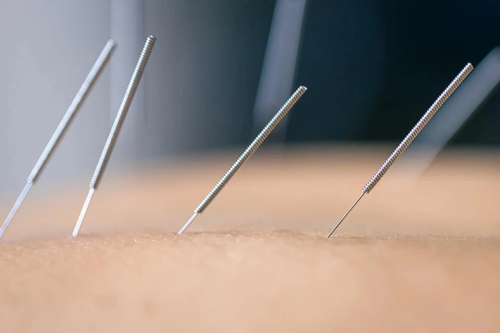 acupuncture and ibs
