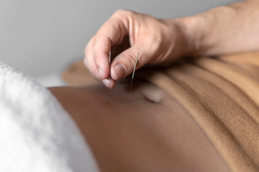 acupuncture for weight loss