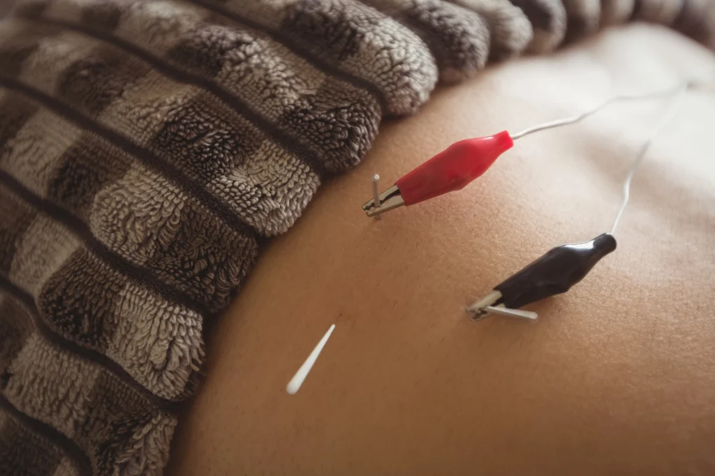 acupuncture therapy for weight loss