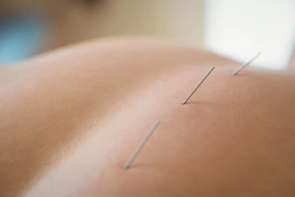 acupuncture for mental health
