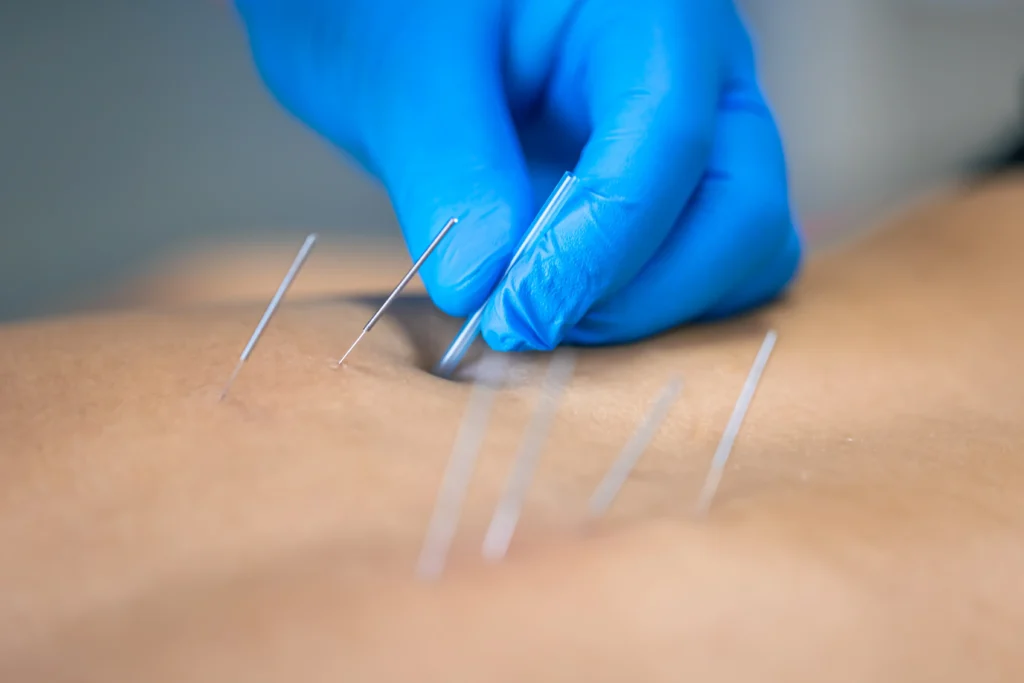 acupuncture for period cramps