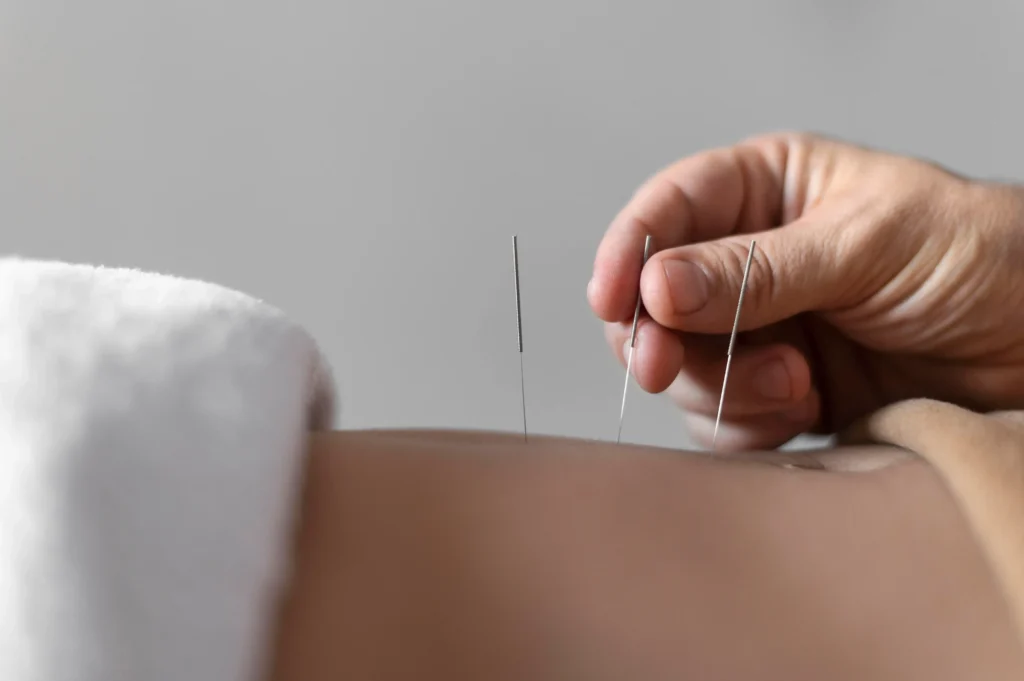 ivf acupuncture