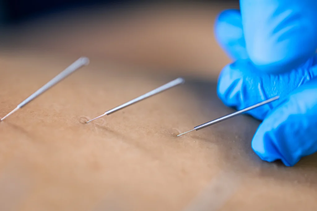 dry needling benefits