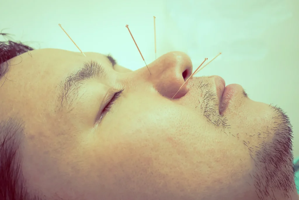 dry needling vs acupuncture