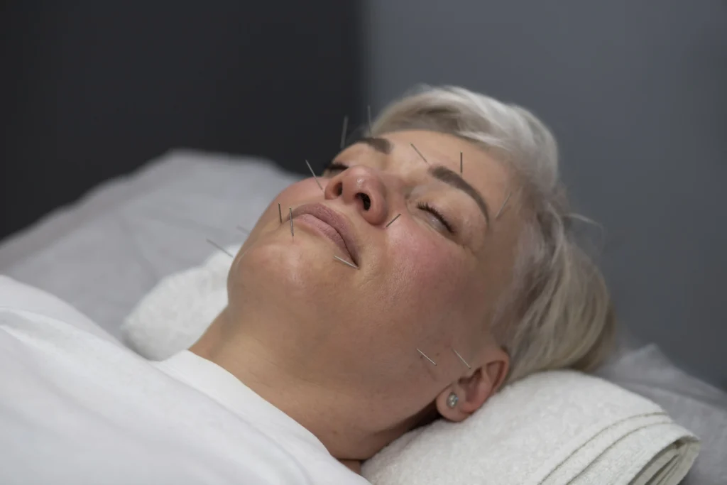top 10 benefits of acupuncture