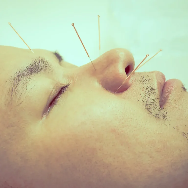 dry needling vs acupuncture