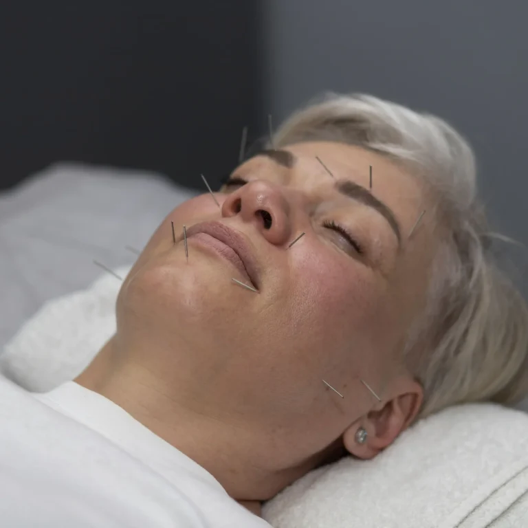 top 10 benefits of acupuncture